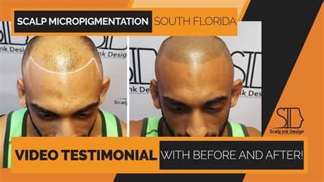 colmek+smp|Miami Scalp Micropigmentation 